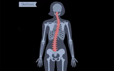 Physical Therapy for Scoliosis